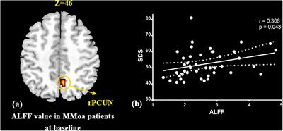 Regulatory Effects of Acupuncture on Emotional Disorders in Patients With Menstrual Migraine Without Aura: A Resting-State fMRI Study